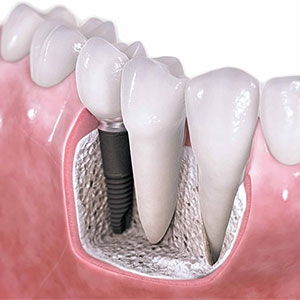 For Restorative Dentistry Choose Oak Springs Dental in Miami Lak For Restorative Dentistry Choose Oak Springs Dental in Miami Lak